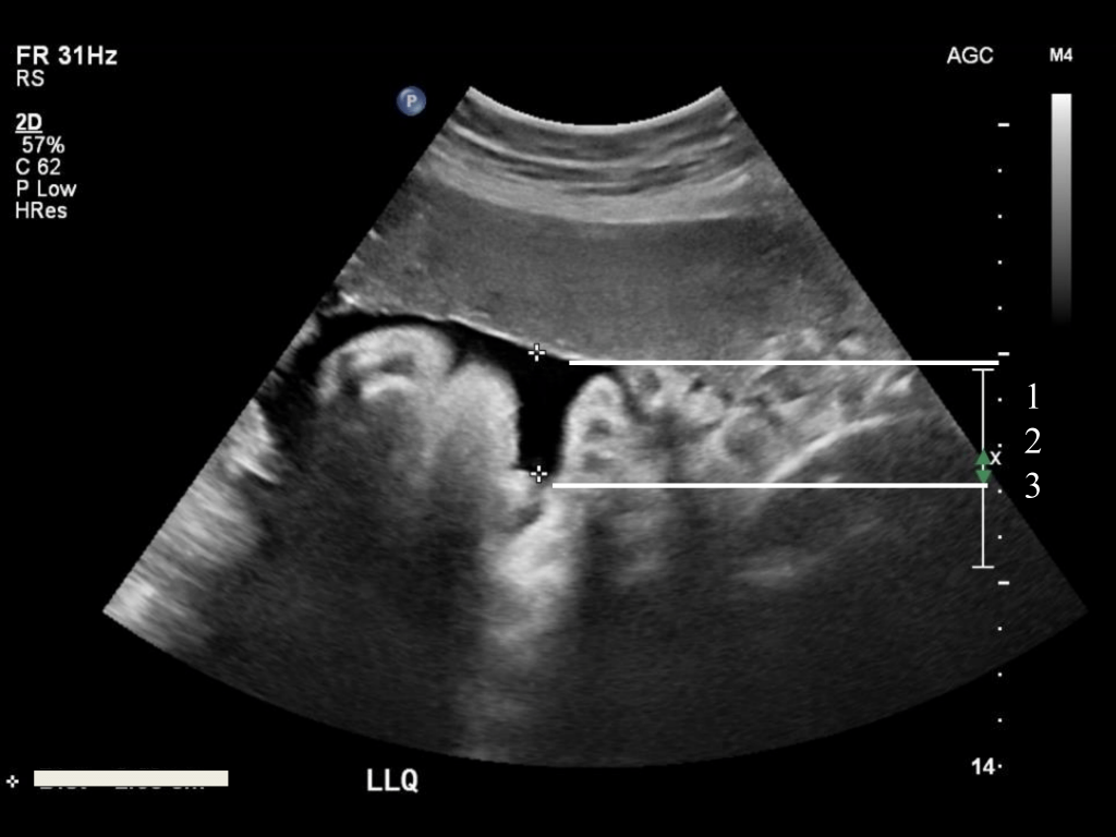 Amniotic Fluid | BCPoCUS