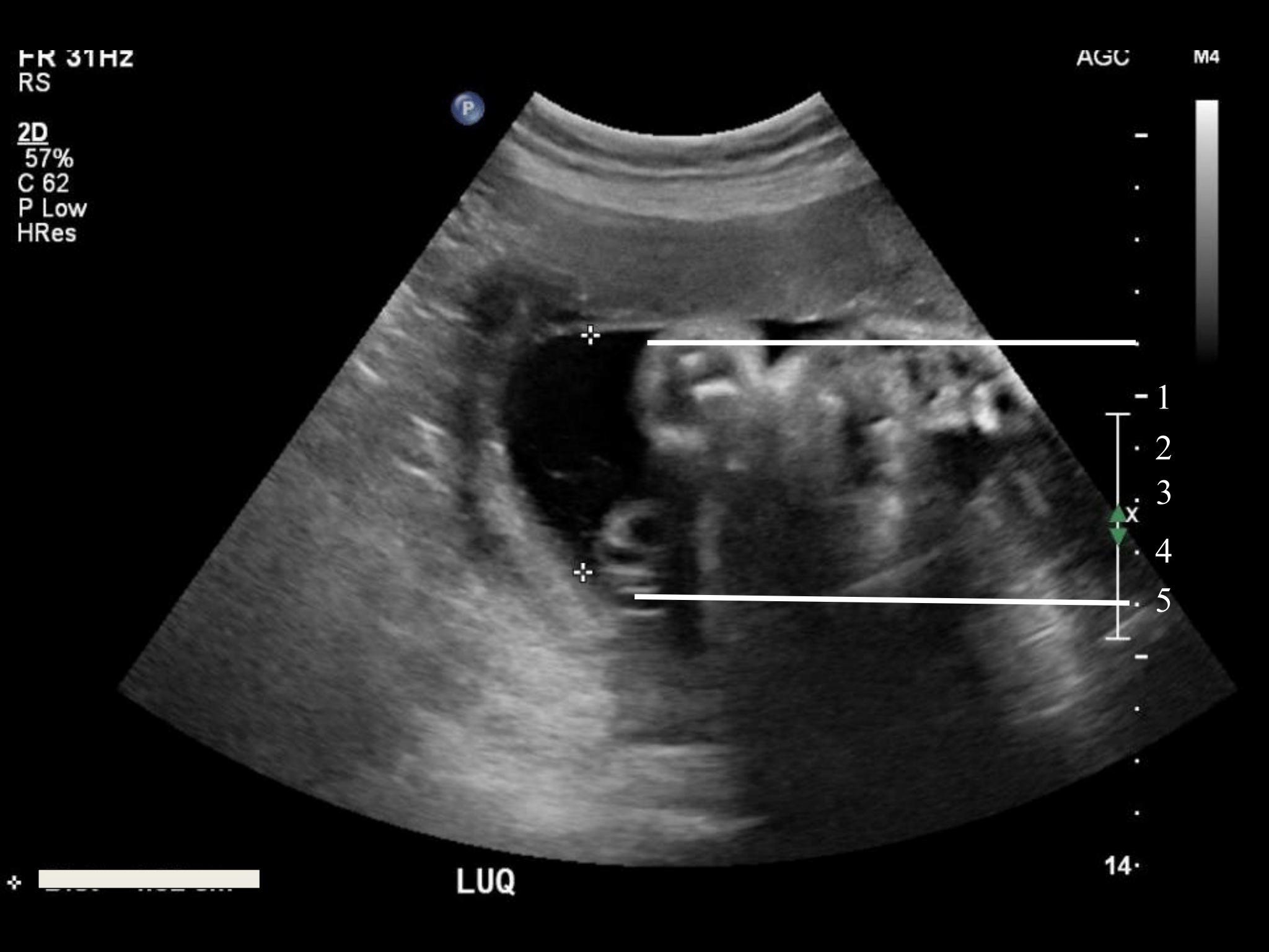 low amniotic fluid at 26 weeks