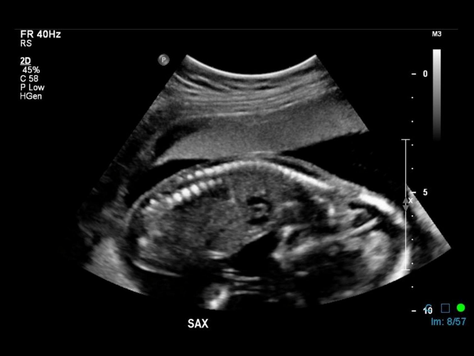 fetal presentation ultrasound image