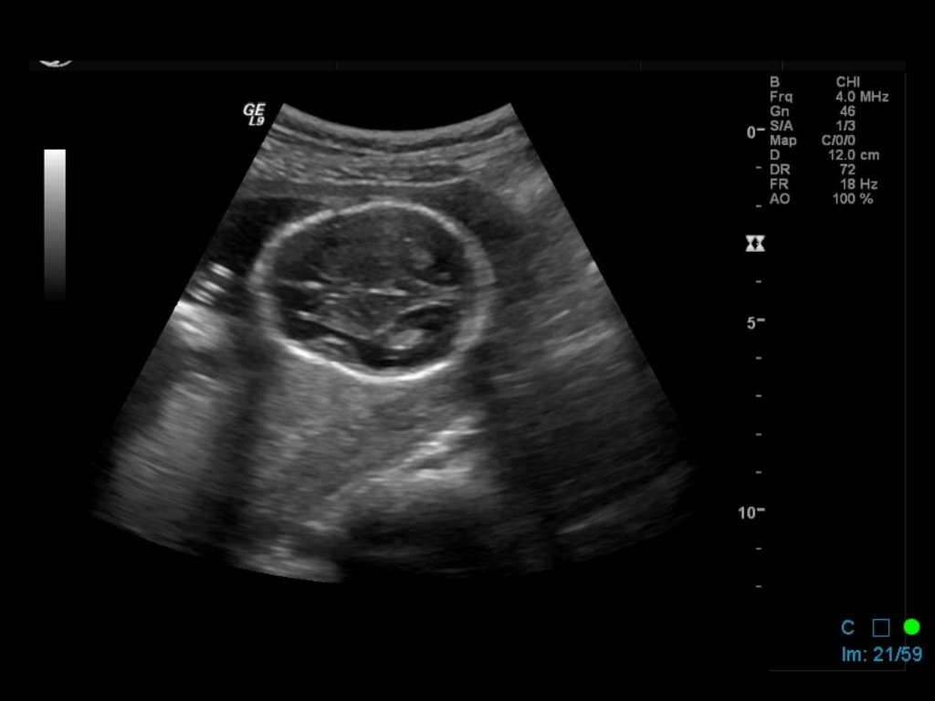 fetal presentation ultrasound report